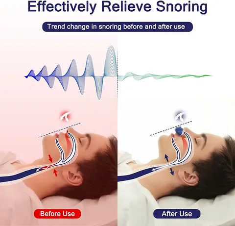換気: いびきのための初のホースレス、マスクレス、ミニ持続気道陽圧 (CPAP)